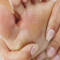 Natural Remedies For Gout
