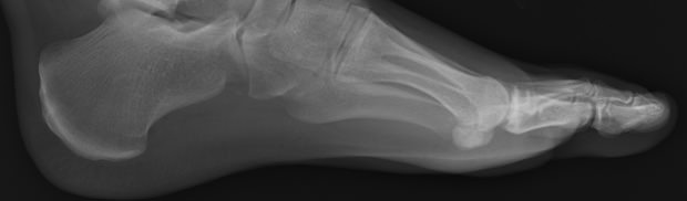 Foot X-ray