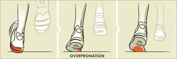 overpronation diagram