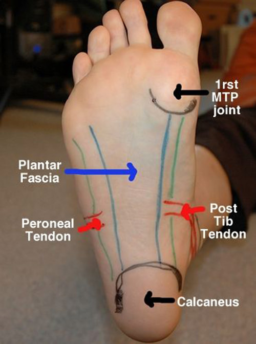 Running Matters #125: Plantar Fascia, 1rst MTP joint, Post Tib Tendon, Calcaneus, Peroneal Tendon Photo Diagram